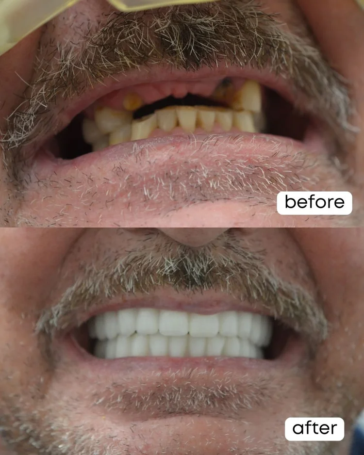 jack+bohm+before+and+after